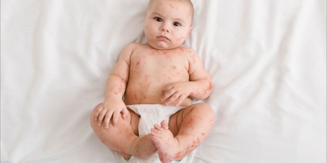 Les cas de rougeole augmentent : comment vous protéger ?